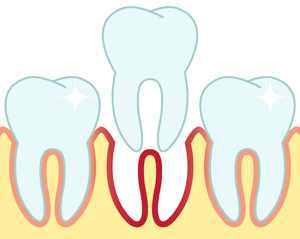 tooth extractions virginia beach